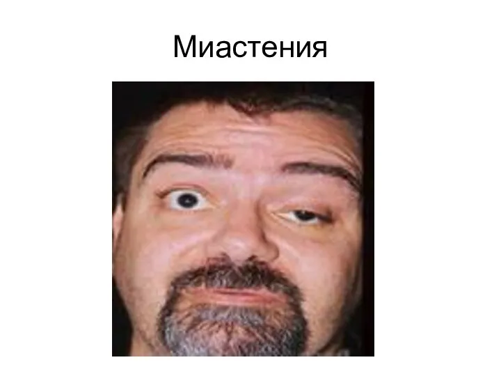 Миастения