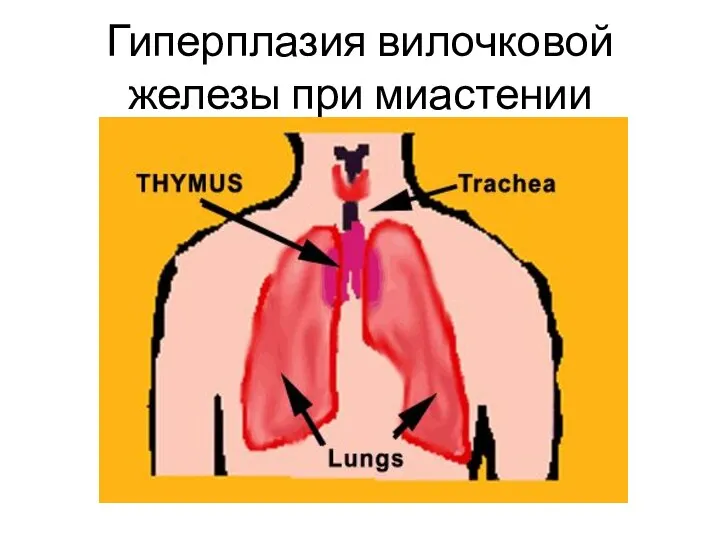 Гиперплазия вилочковой железы при миастении