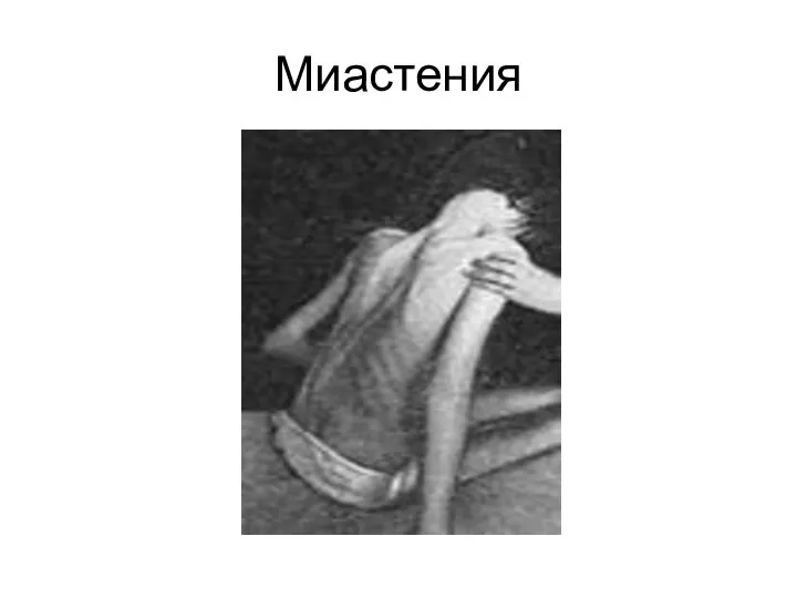 Миастения