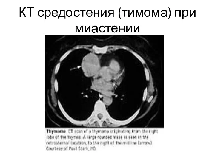 КТ средостения (тимома) при миастении