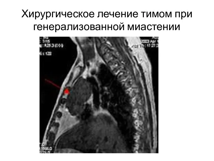 Хирургическое лечение тимом при генерализованной миастении