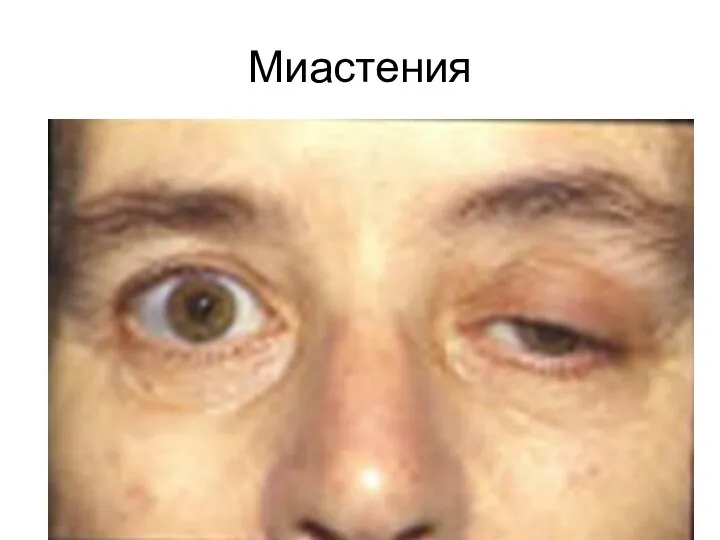 Миастения