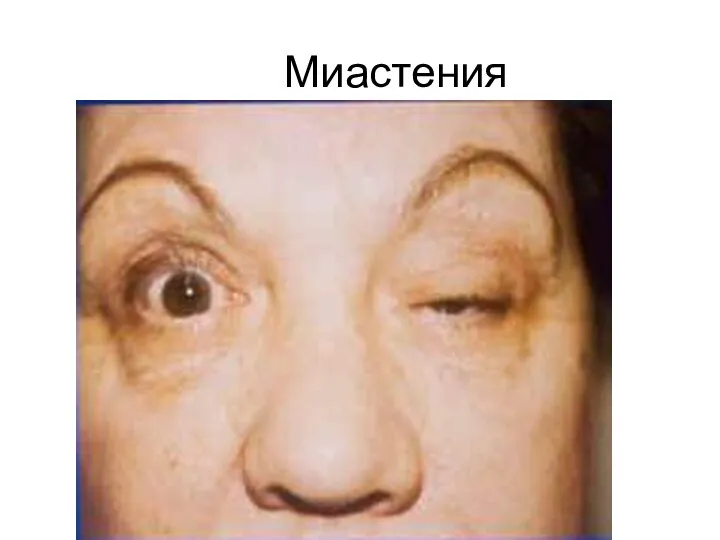 Миастения