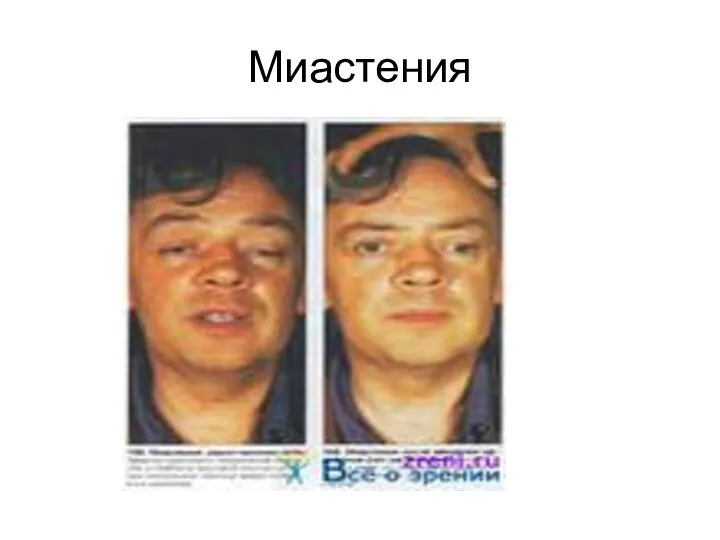 Миастения