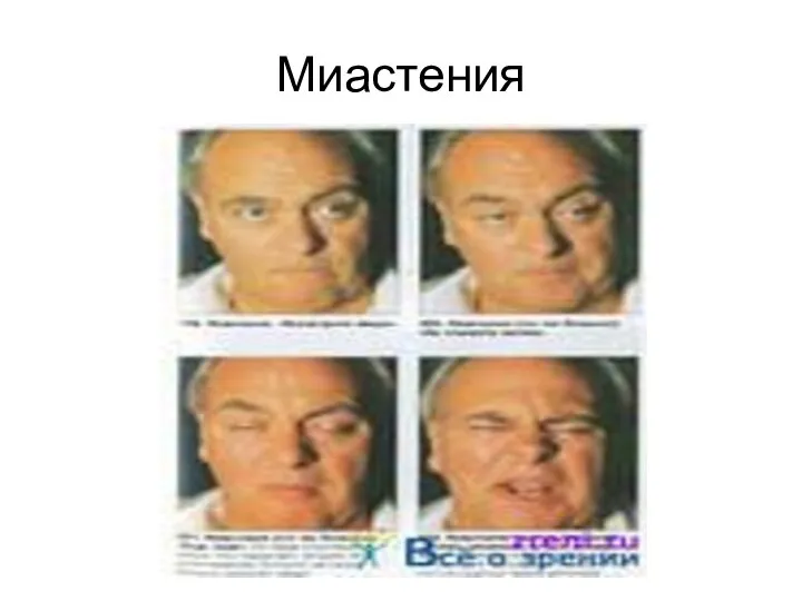 Миастения