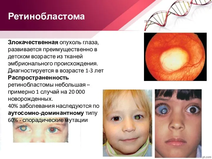 Ретинобластома Злокачественная опухоль глаза, развивается преимущественно в детском возрасте из тканей