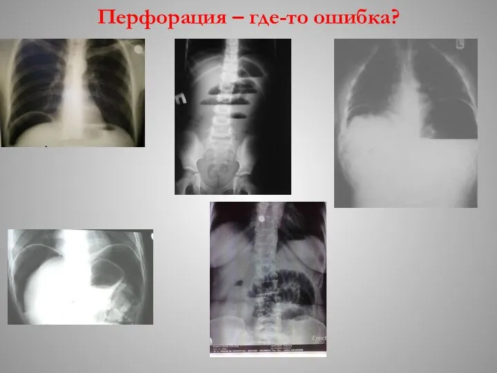 Перфорация – где-то ошибка?