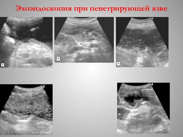 Эхоэндоскопия при пенетрирующей язве