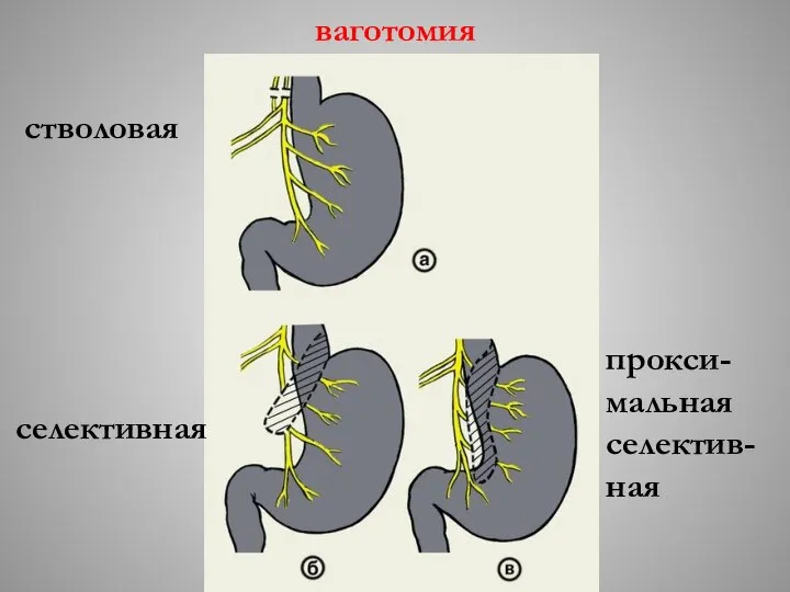 ваготомия стволовая селективная прокси-мальная селектив-ная