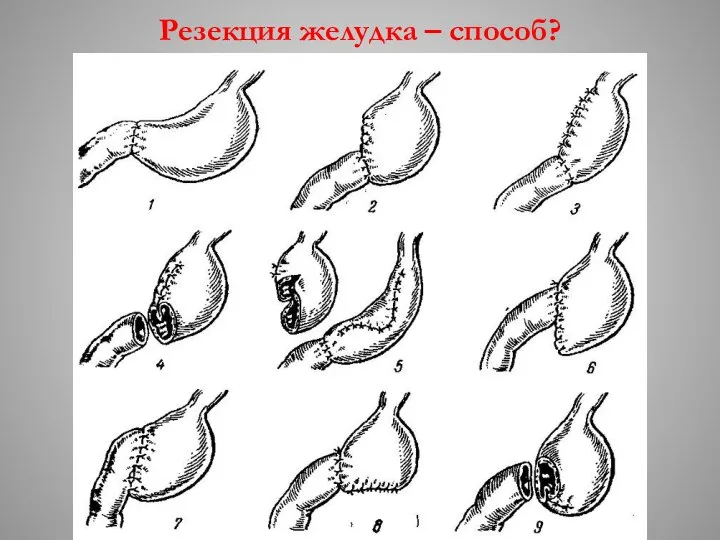 Резекция желудка – способ?