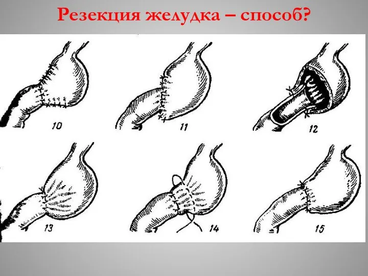 Резекция желудка – способ?