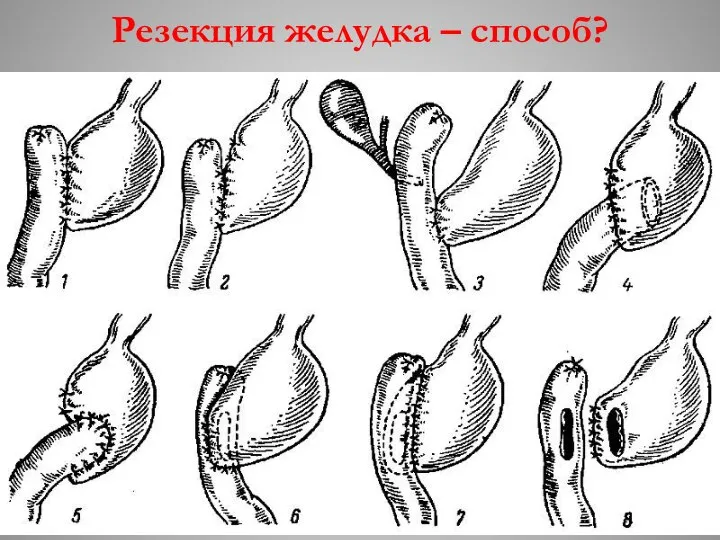 Резекция желудка – способ?