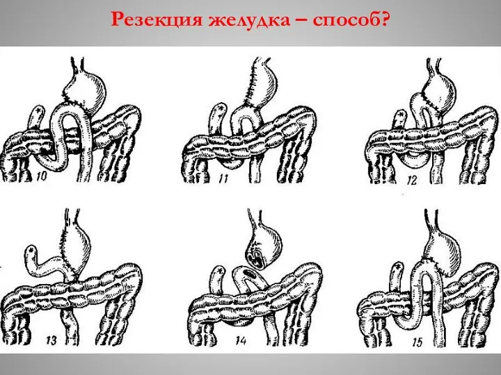 Резекция желудка – способ?