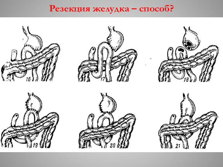 Резекция желудка – способ?