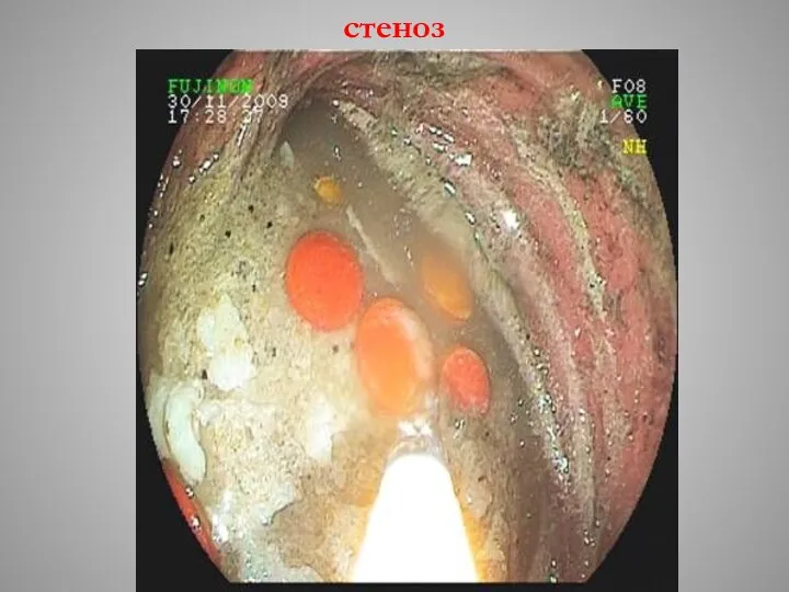 стеноз