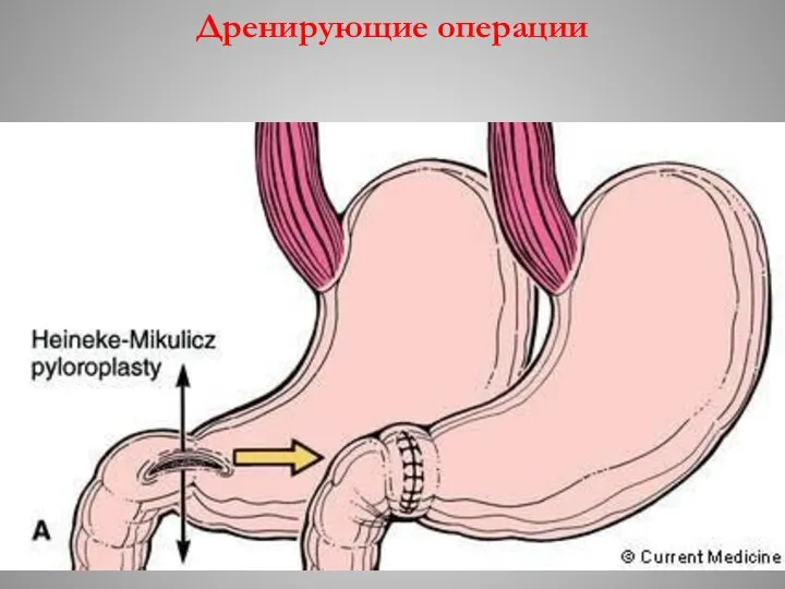 Дренирующие операции