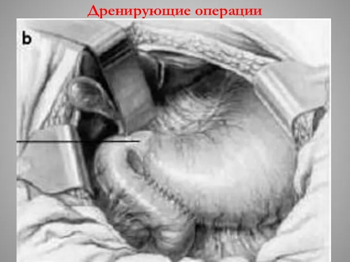 Дренирующие операции