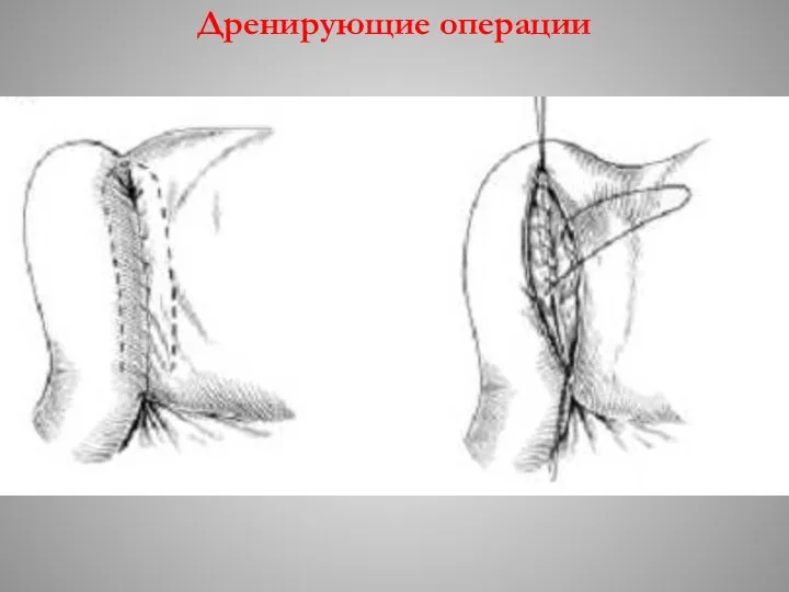 Дренирующие операции