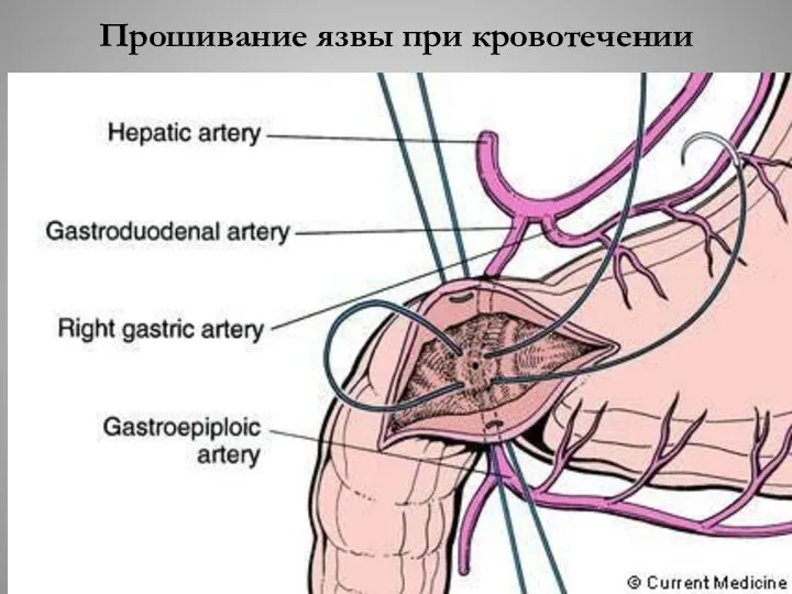 Прошивание язвы при кровотечении