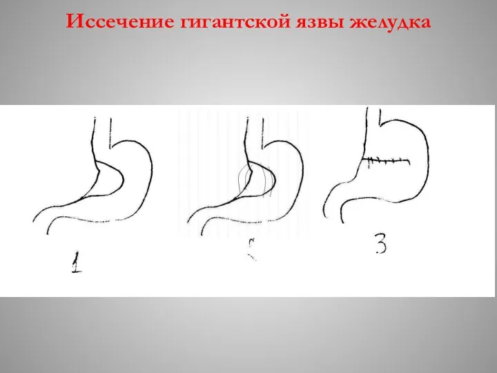 Иссечение гигантской язвы желудка