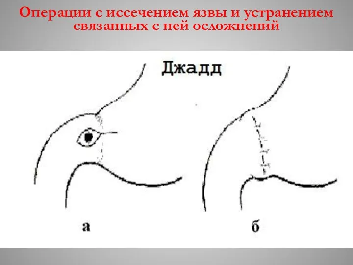 Операции с иссечением язвы и устранением связанных с ней осложнений