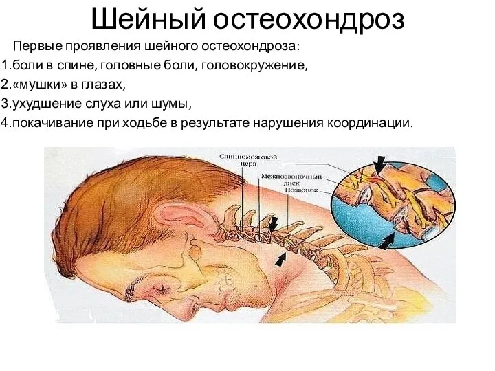 Шейный остеохондроз Первые проявления шейного остеохондроза: боли в спине, головные боли,