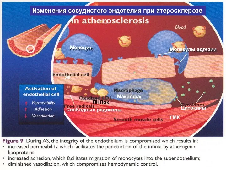 Молекулы адгезии Моноцит Макрофаг ГМК Цитокины Свободные радикалы ЛНПок ЭК Изменения сосудистого эндотелия при атеросклерозе