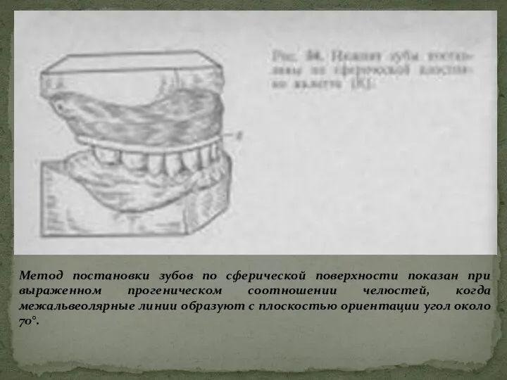 Метод постановки зубов по сферической поверхности показан при выраженном прогеническом соотношении