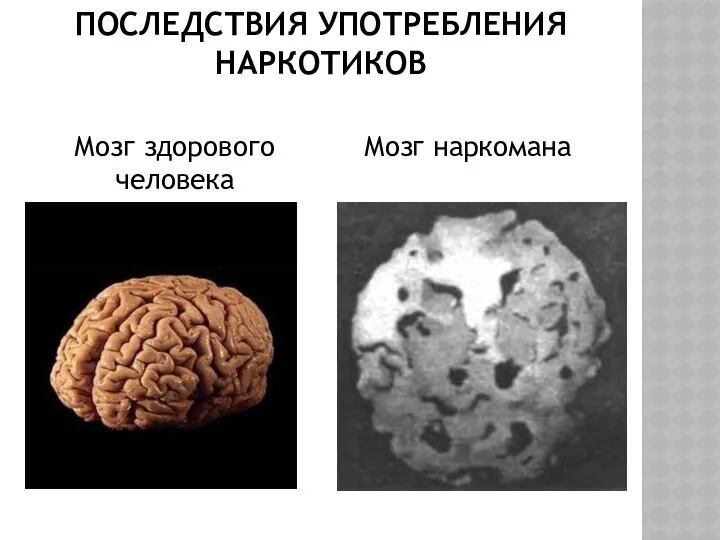 ПОСЛЕДСТВИЯ УПОТРЕБЛЕНИЯ НАРКОТИКОВ Мозг наркомана Мозг здорового человека