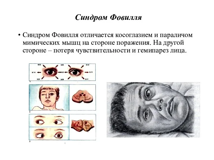 Синдром Фовилля Синдром Фовилля отличается косоглазием и параличом мимических мышц на