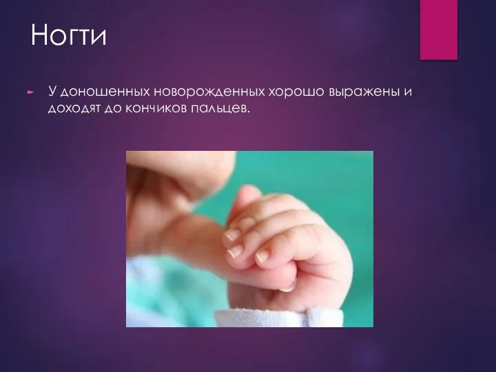Ногти У доношенных новорожденных хорошо выражены и доходят до кончиков пальцев.