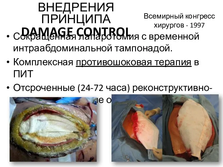 Всемирный конгресс хирургов - 1997 Сокращенная лапаротомия с временной интраабдоминальной тампонадой.