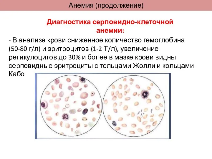 Анемия (продолжение) Диагностика серповидно-клеточной анемии: - В анализе крови сниженное количество