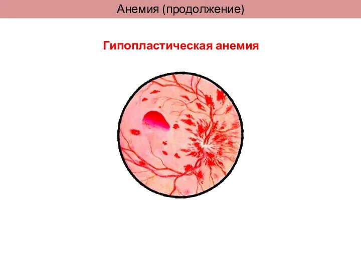 Анемия (продолжение) Гипопластическая анемия