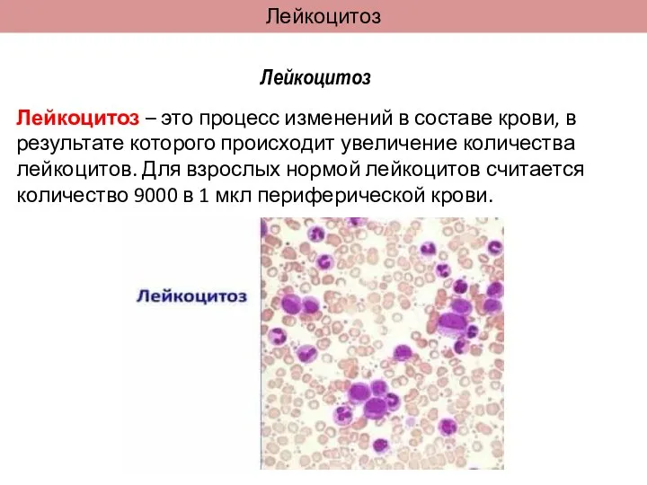 Лейкоцитоз Лейкоцитоз Лейкоцитоз – это процесс изменений в составе крови, в