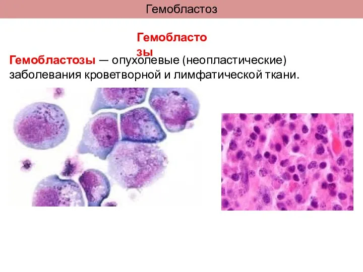 Гемобластоз Гемобластозы — опухолевые (неопластические) заболевания кроветворной и лимфатической ткани. Гемобластозы