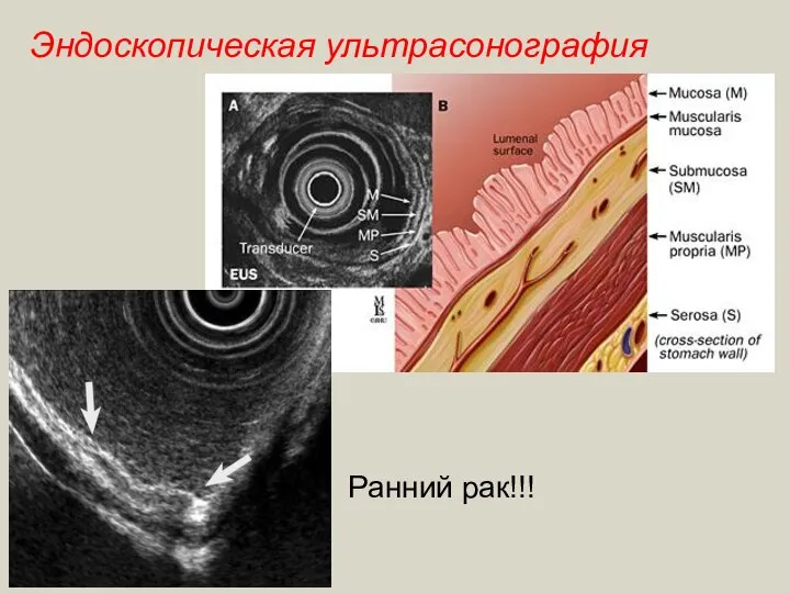 Эндоскопическая ультрасонография Ранний рак!!!