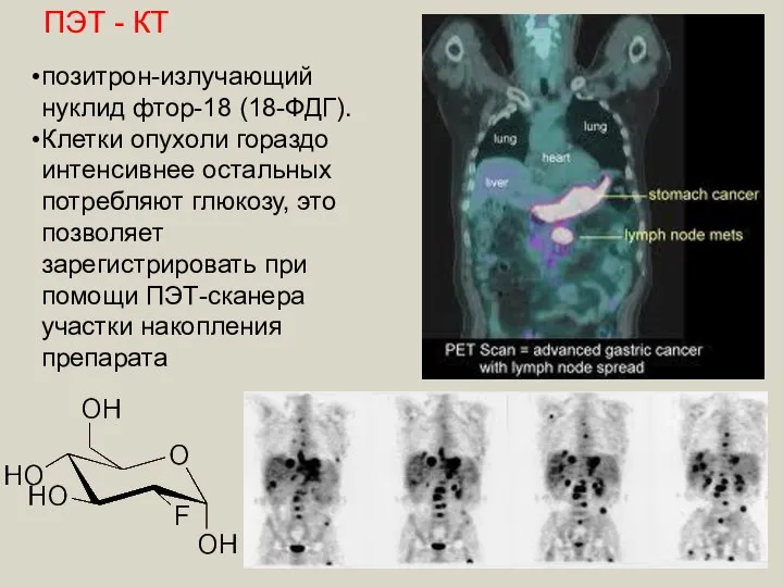 ПЭТ - КТ позитрон-излучающий нуклид фтор-18 (18-ФДГ). Клетки опухоли гораздо интенсивнее