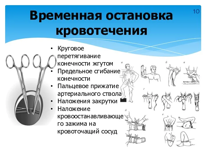 Временная остановка кровотечения Круговое перетягивание конечности жгутом Предельное сгибание конечности Пальцевое