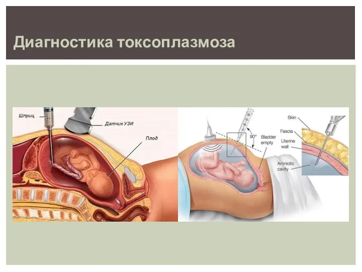 Диагностика токсоплазмоза