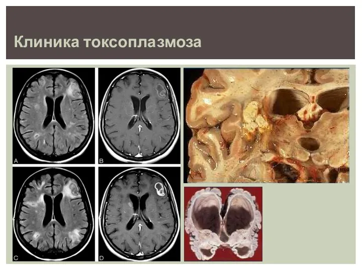 Клиника токсоплазмоза