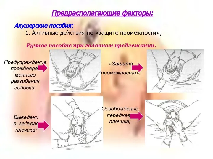 Предрасполагающие факторы: Акушерские пособия: 1. Активные действия по «защите промежности»; Ручное