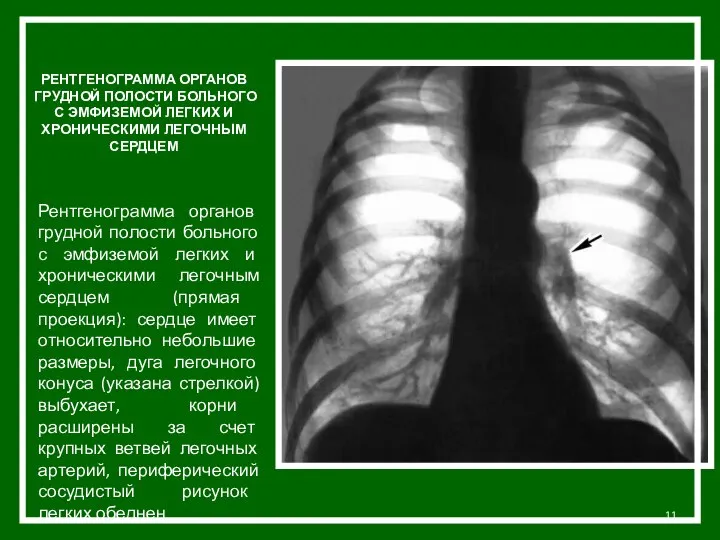 РЕНТГЕНОГРАММА ОРГАНОВ ГРУДНОЙ ПОЛОСТИ БОЛЬНОГО С ЭМФИЗЕМОЙ ЛЕГКИХ И ХРОНИЧЕСКИМИ ЛЕГОЧНЫМ