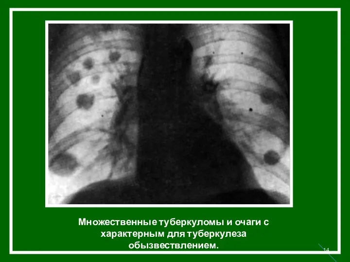 Множественные туберкуломы и очаги с характерным для туберкулеза обызвествлением.