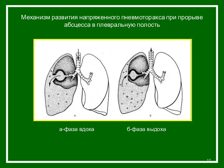 Механизм развития напряженного пневмоторакса при прорыве абсцесса в плевральную полость а-фаза вдоха б-фаза выдоха