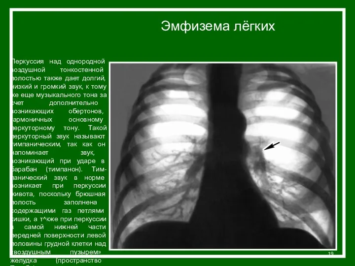 Перкуссия над однородной воздушной тонкостенной полостью также дает долгий, низкий и