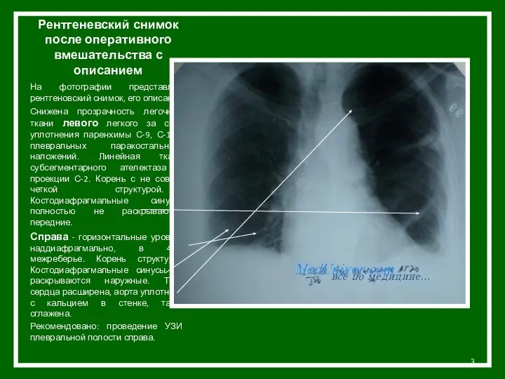 Рентгеневский снимок после оперативного вмешательства с описанием На фотографии представлен рентгеновский