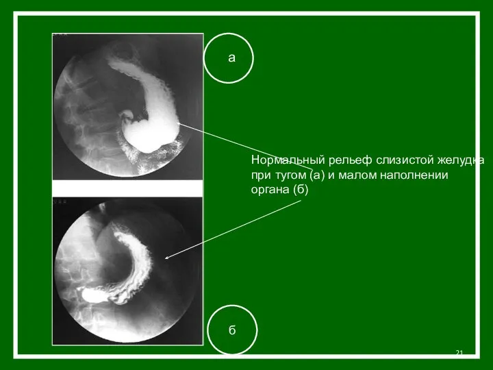 а Нормальный рельеф слизистой желудка при тугом (а) и малом наполнении органа (б) б