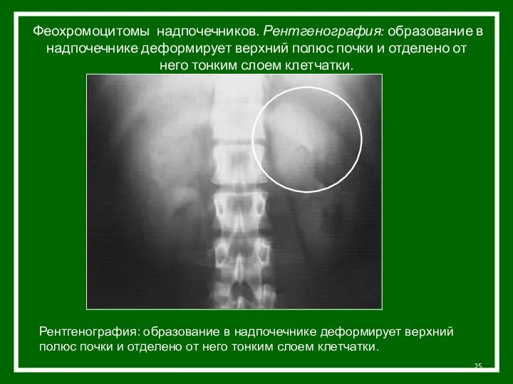 Феохромоцитомы надпочечников. Рентгенография: образование в надпочечнике деформирует верхний полюс почки и