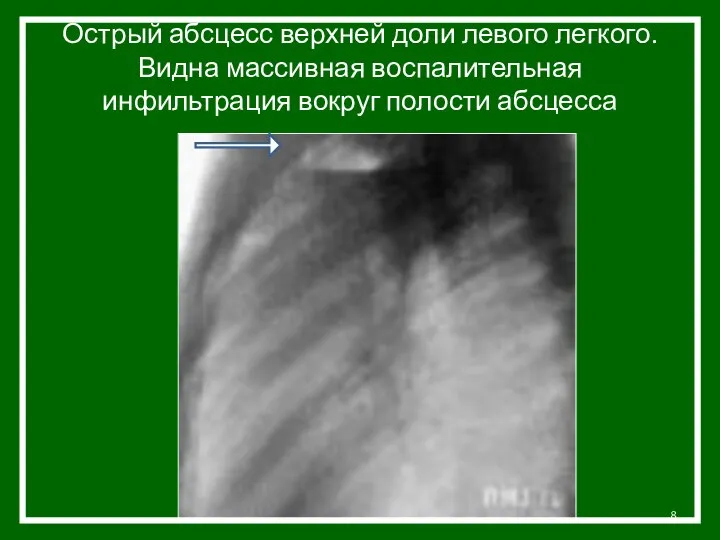 Острый абсцесс верхней доли левого легкого. Видна массивная воспалительная инфильтрация вокруг полости абсцесса